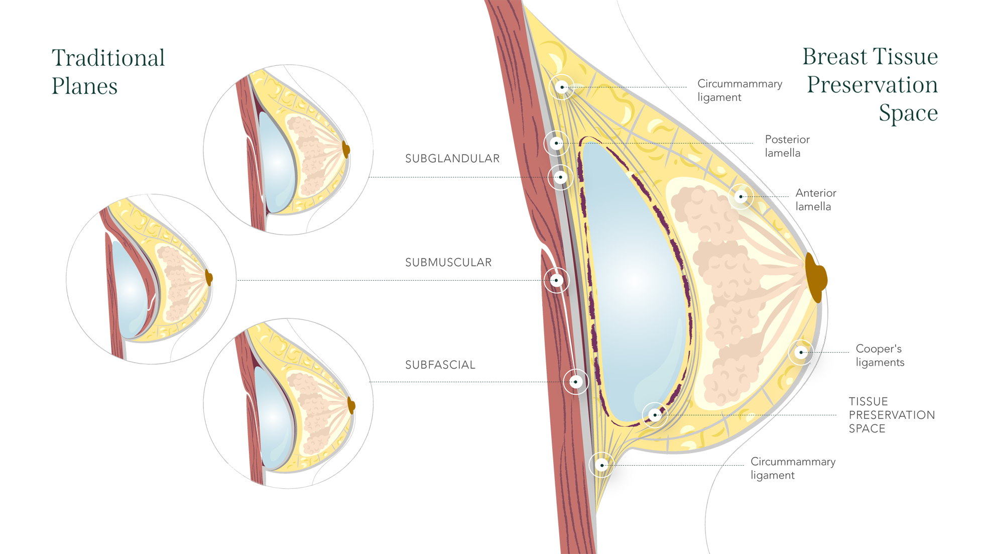 preserve-implantat-position Schema der Implantat-Positionierung bei der Preserve-Technik